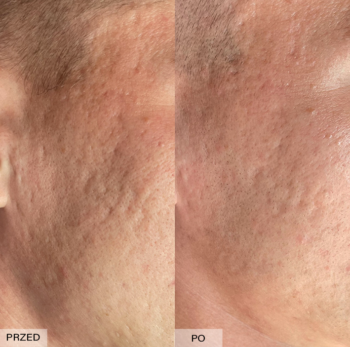 usuwanie blizn efekty